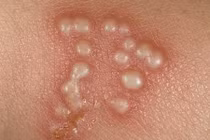 Bí kíp phòng mụn cóc sinh dục nam giới cực đỉnh