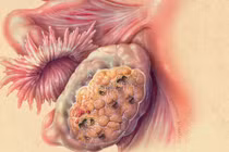 Dấu hiệu cảnh báo bạn mắc ung thư buồng trứng