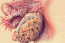 Dấu hiệu cảnh báo bạn mắc ung thư buồng trứng