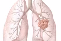 Dấu hiệu nhận dạng các loại ung thư thường gặp