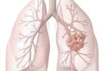 Dấu hiệu nhận dạng các loại ung thư thường gặp