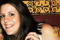 Mắc ung thư da, thiếu nữ suýt chết vì nhầm vết bẩn