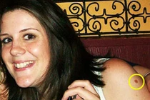 Mắc ung thư da, thiếu nữ suýt chết vì nhầm vết bẩn