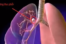 Sự thật đáng sợ về ung thư phổi