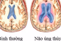 Bí ẩn căn bệnh não úng thủy của Quốc vương Thái Lan