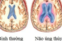 Bí ẩn căn bệnh não úng thủy của Quốc vương Thái Lan