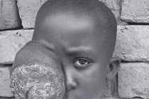 Cuộc sống địa ngục của bé gái có khối u dị dạng