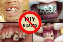 Hậu quả khủng khiếp của niềng răng bằng dây thun tại nhà