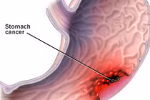 Điểm danh 10 bệnh ung thư cực nguy hiểm