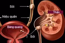 Tiết lộ lý do khiến bạn tiểu tiện nhiều lần trong ngày