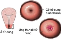 Cách tự phát hiện ung thư cổ tử cung tại nhà