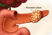 Thực phẩm gây ung thư tuyến tụy nên tránh xa