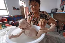 Thảm cảnh em bé da bọc xương, bụng căng đầy chất thải