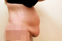 Chi gần nửa tỷ cắt da thừa ở bụng để mặc bikini