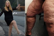 Người phụ nữ hút 12 lít mỡ thừa ở chân để giảm béo