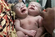 Thương tâm những em bé sơ sinh dị tật 2 đầu