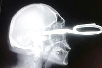 Quý ông bị đâm kéo vào đầu vẫn sống sót kỳ diệu