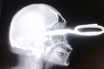 Quý ông bị đâm kéo vào đầu vẫn sống sót kỳ diệu