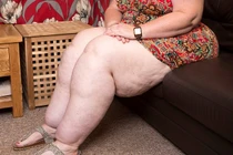 Hoảng hồn người phụ nữ có đôi chân nặng hơn nửa tạ