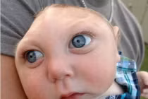 Kỳ dị em bé không có hộp sọ vẫn sống khỏe mạnh