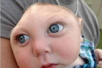 Kỳ dị em bé không có hộp sọ vẫn sống khỏe mạnh