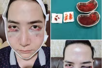 Mặt hotboy Thái Lan méo mó phát sợ vì tiêm silicon lỏng