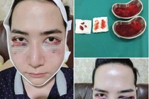 Mặt hotboy Thái Lan méo mó phát sợ vì tiêm silicon lỏng