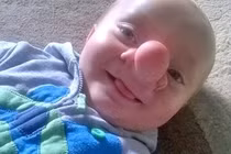 Bé 21 tháng tuổi mắc bệnh lạ có não trong mũi