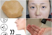 Những kiểu nâng mũi tạm thời gây choáng váng