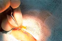 Khiếp đảm ký sinh trùng dài 12 cm luồn trong mắt