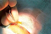 Khiếp đảm ký sinh trùng dài 12 cm luồn trong mắt