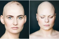 Ngắm nhan sắc tuyệt đẹp của phụ nữ bị hội chứng “đầu trọc“