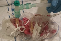 Ngắm em bé sinh non 0,5kg sống sót nhờ túi đựng bánh