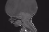 Sốc nặng em bé không có não vẫn sống khỏe, biết gọi mẹ