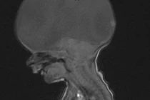 Sốc nặng em bé không có não vẫn sống khỏe, biết gọi mẹ