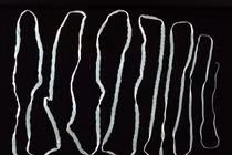 Khiếp đảm sán xơ mít 12m trong ruột bệnh nhân ở Huế