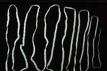 Khiếp đảm sán xơ mít 12m trong ruột bệnh nhân ở Huế