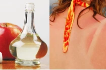 Da cháy nắng đen sì, làm sao để nhanh trắng lại?