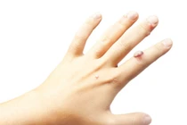 Mẹo dân gian trị mụn cóc nhanh khỏi không đau đớn