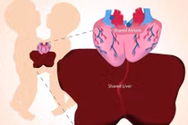 Cận cảnh ca phẫu thuật tách cặp song sinh dính liền tim