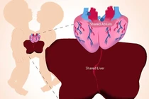 Cận cảnh ca phẫu thuật tách cặp song sinh dính liền tim