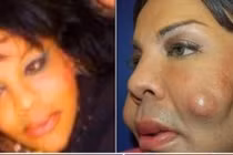  Hình ảnh nổi da gà những cơ thể biến dạng vì dao kéo