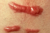 7 cách chữa sẹo lồi cực đơn giản tại nhà