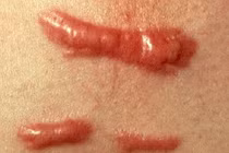 7 cách chữa sẹo lồi cực đơn giản tại nhà