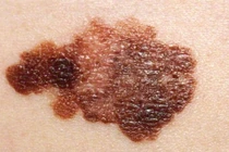 Ngừa ung thư da bằng virus gây mụn rộp sinh dục