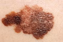 Ngừa ung thư da bằng virus gây mụn rộp sinh dục