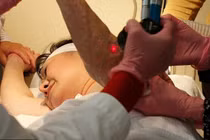 Chi tiết quy trình trị sẹo bỏng bằng laser cho “em bé Napalm“