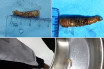 Kinh hoàng con sâu dài 3cm ký sinh trong mắt bệnh nhân