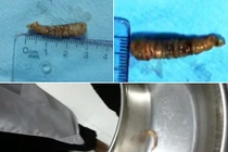 Kinh hoàng con sâu dài 3cm ký sinh trong mắt bệnh nhân