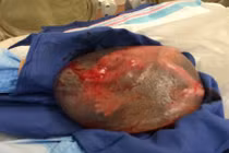 Kỳ lạ em bé sinh ra vẫn nằm trong túi ối